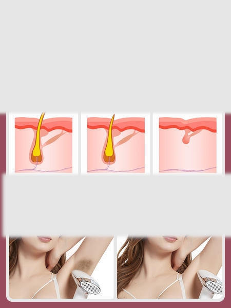 Aparatas viso kūno plaukų šalinimui lazeriu