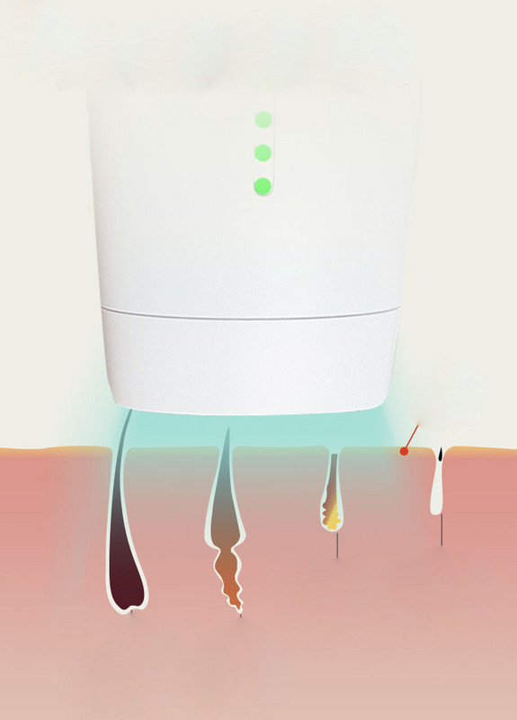 Aparatas viso kūno plaukų šalinimui lazeriu